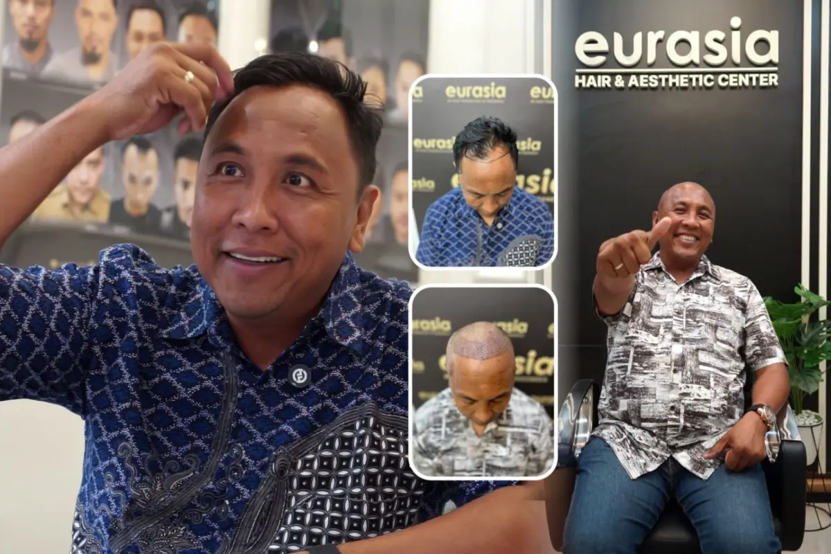 Eurasia Clinic Hair Transplant Klinik Nomor 1 di Indonesia, Dorong Yogyakarta jadi Pusat Medical Tourism Dunia