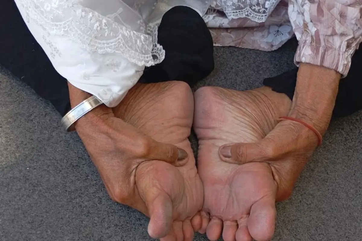 Waspada Kaki Melepuh, Jemaah Haji Diimbau Lindungi Kaki dari Panas Lantai