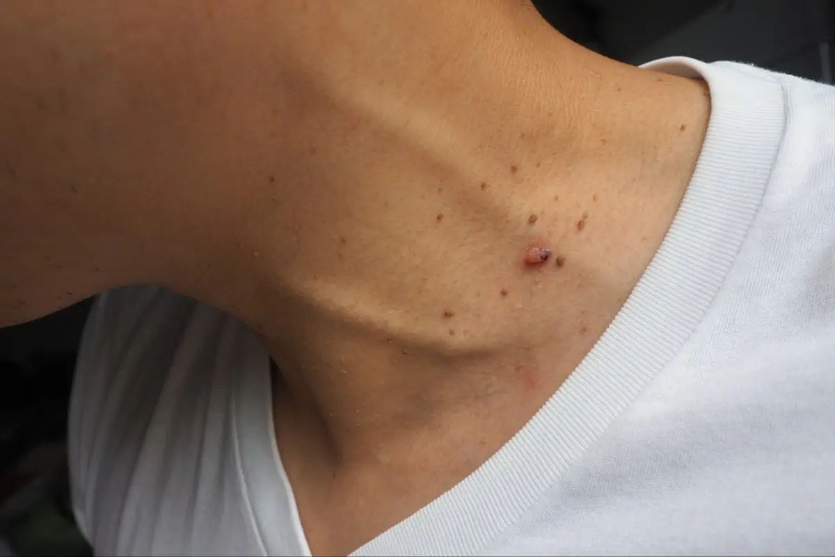 Skin Tag: Kenali Penyebab Benjolan Kecil di Kulit - TIMES Indonesia